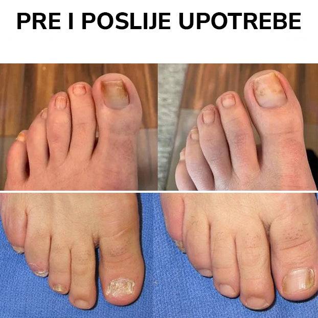 Kapi Protiv Gljivica